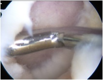 Chondral Lesion 5 mm